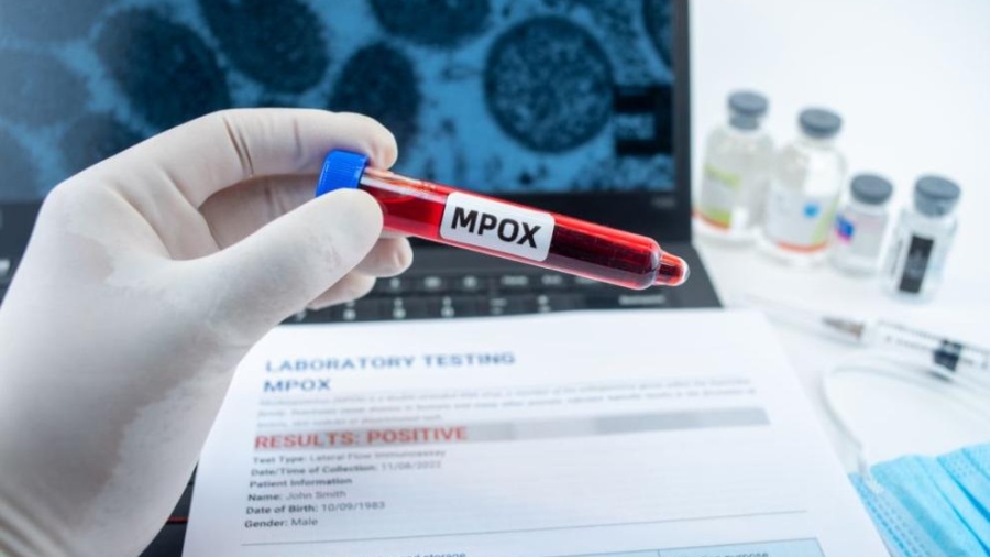 За първи път случаи на маймунска шарка са регистрирани в Северна Македония